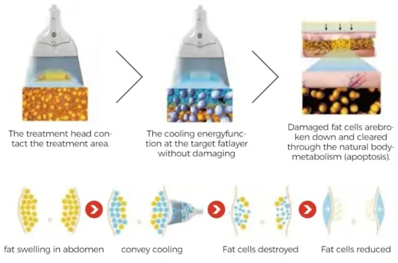 360 Cryo Fat Freezing machine 2 360 Cryo Fat Freezing machine 2
