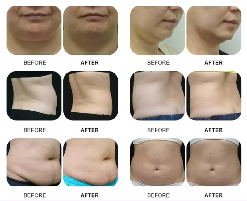 360 Cryo Fat Freezing machine 15 360 Cryo Fat Freezing machine 15